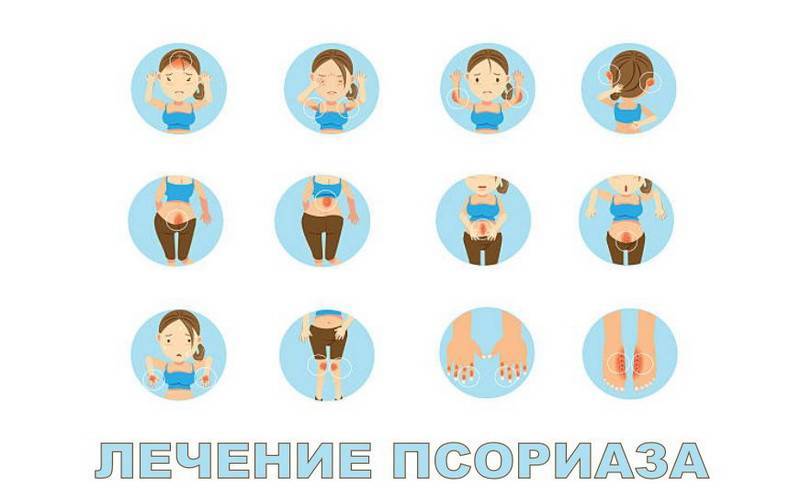 Лечение псориаза в санаториях россии: польза, эффективность, фото